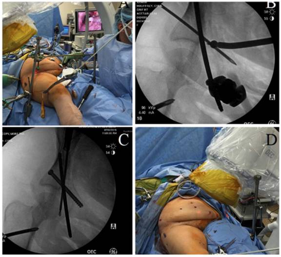腹腔镜辅助复位髋臼骨折的病例介绍及解决办法！