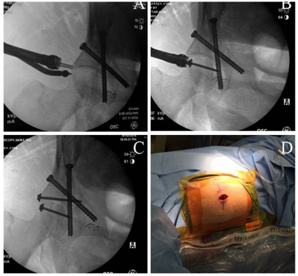 腹腔镜辅助复位髋臼骨折的病例介绍及解决办法！